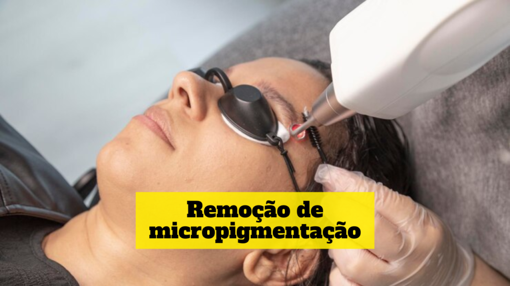 remoção de micropigmentação