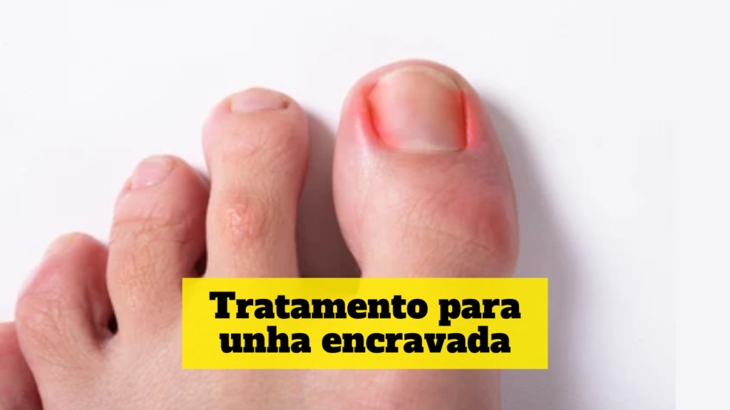 tratamento para unha encravada