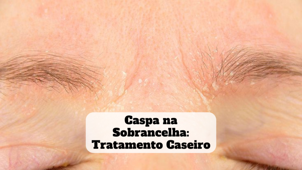 caspa na sobrancelha tratamento caseiro