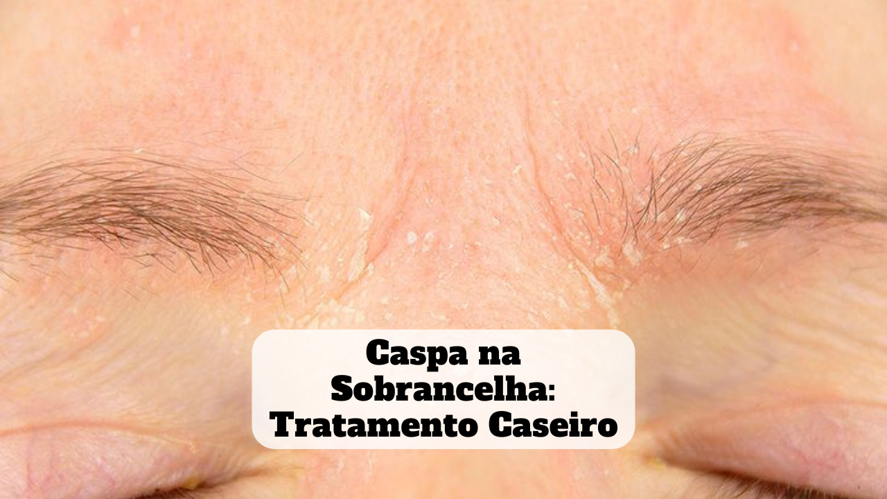 caspa na sobrancelha tratamento caseiro